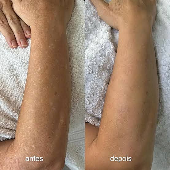 FOTO-LEUCODERMIA.jpg
